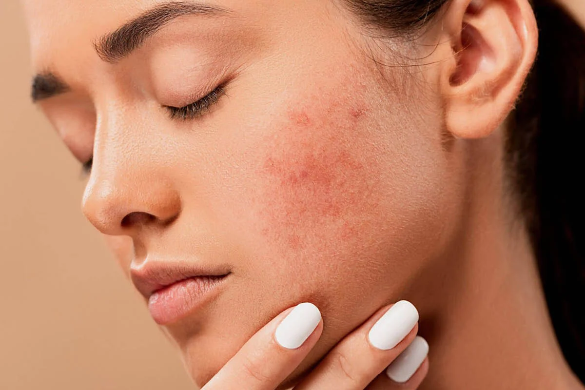 Close-up of acne on woman's cheek