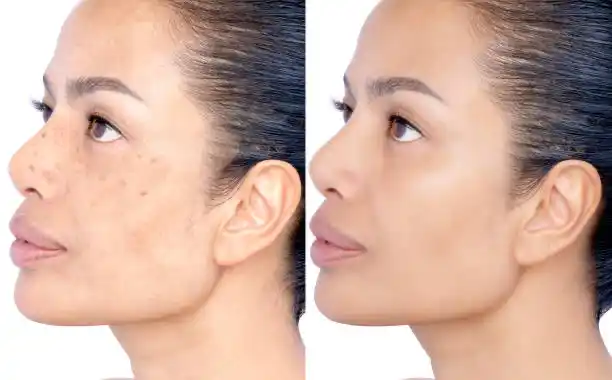 Before and after skin treatment